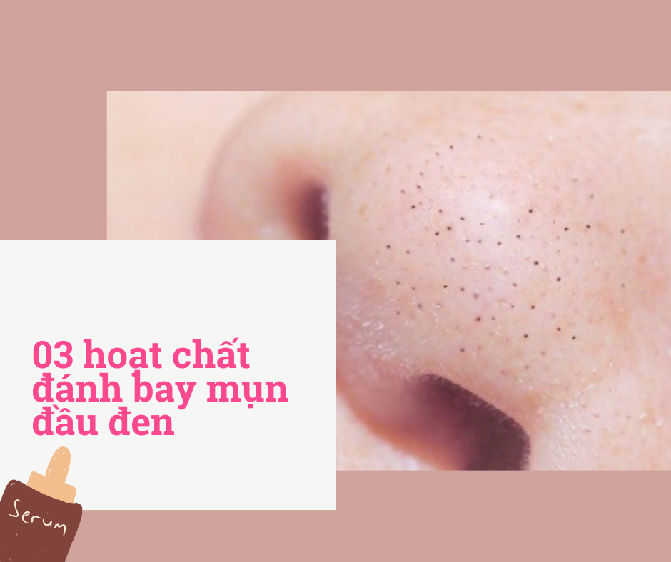 3 hoạt chất đánh bay mụn đầu đen